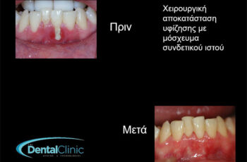 250408-ΜΟΝΗΡΗΣ-ΥΦΙΖΗΣΗ